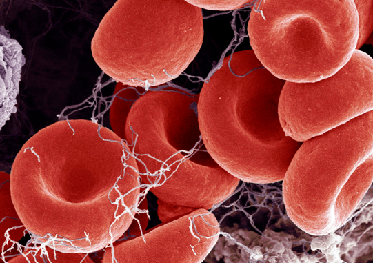 Blood clots due to smoking.