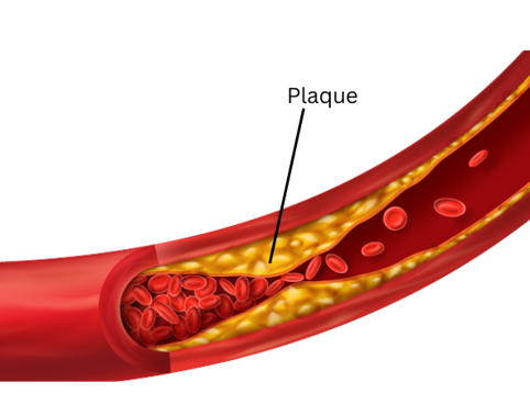 Clogged arteries due to smoking.