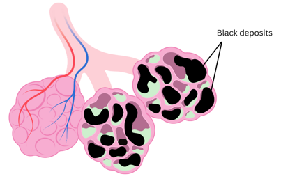 Alveoli in the lungs destroyed by emphysema.