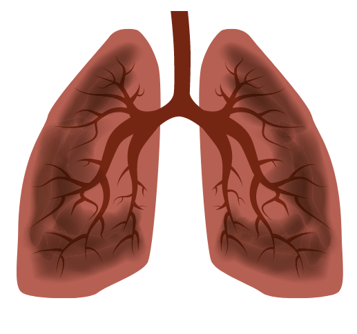 Blackened smoker's lungs caused by smoking.